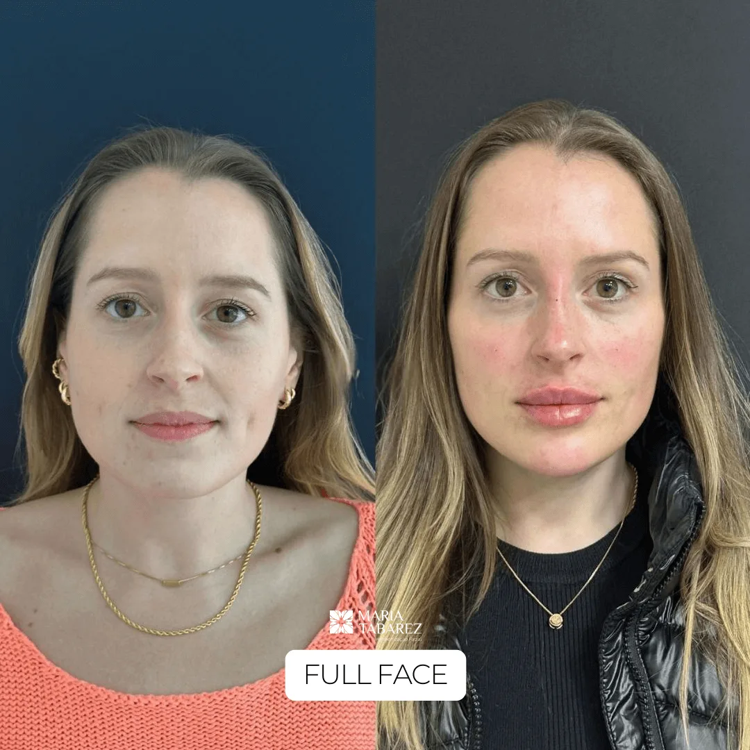 Full Face — antes e depois · Maria Tabarez