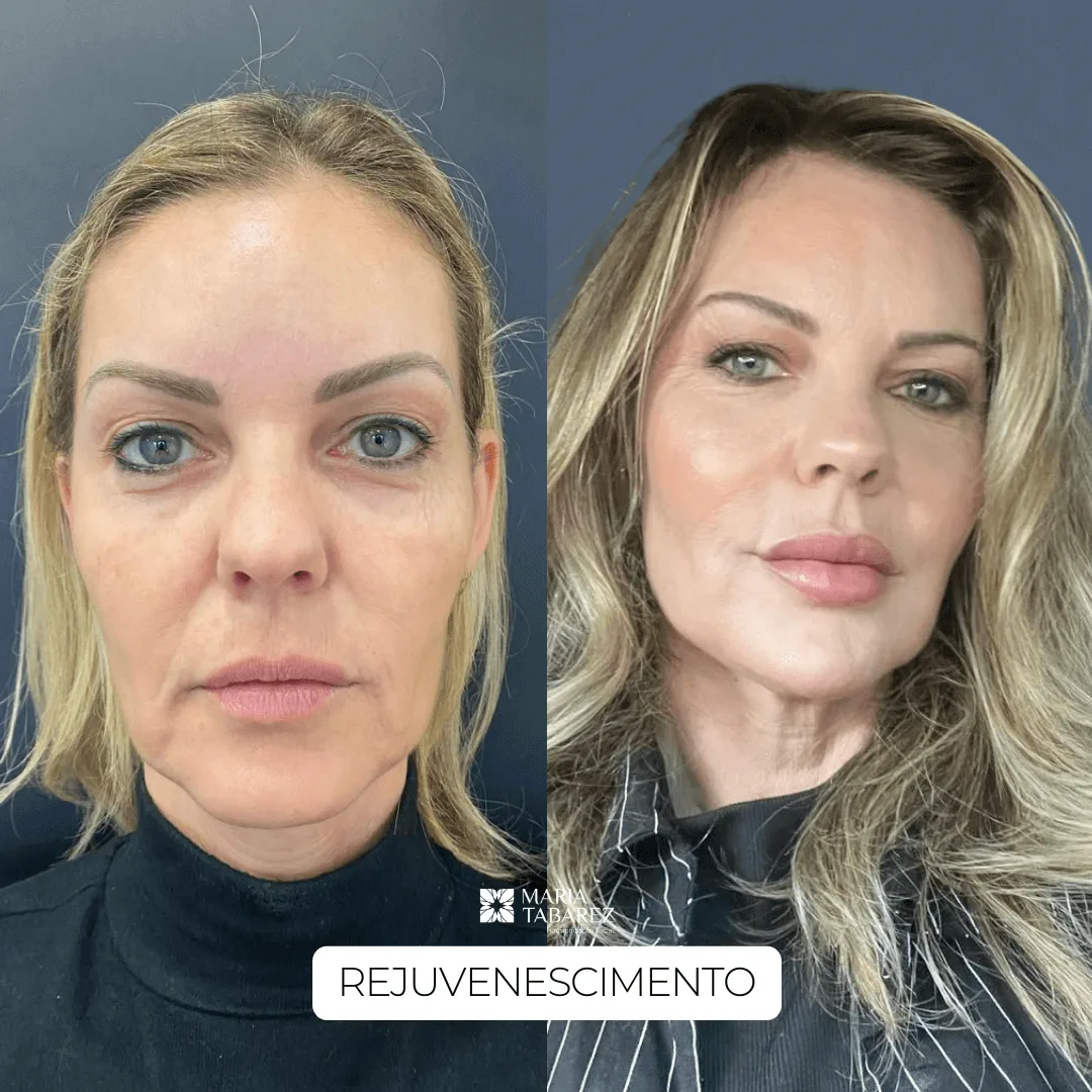 Full Face — antes e depois · Maria Tabarez