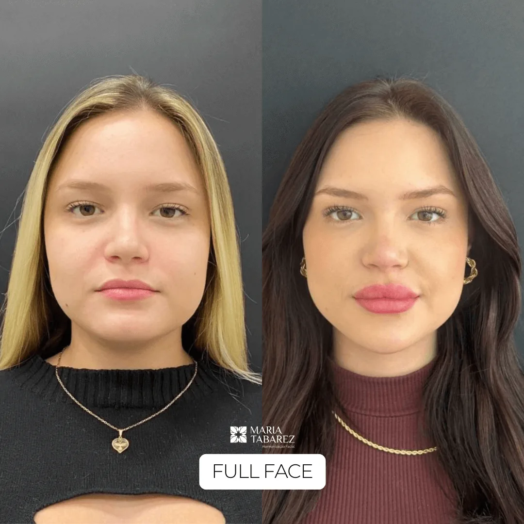 Full Face — antes e depois · Maria Tabarez