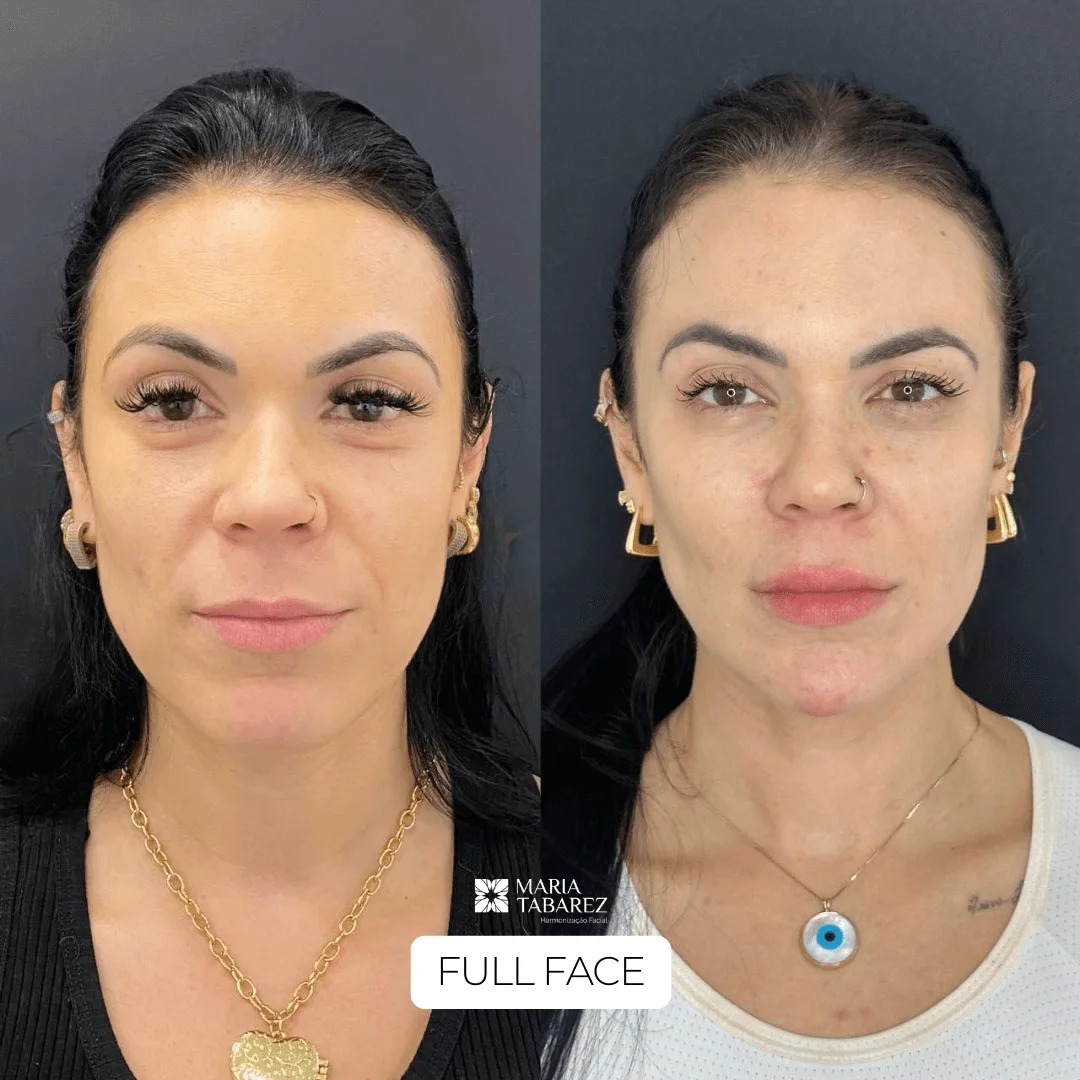 Perfiloplastia — antes e depois · Maria Tabarez