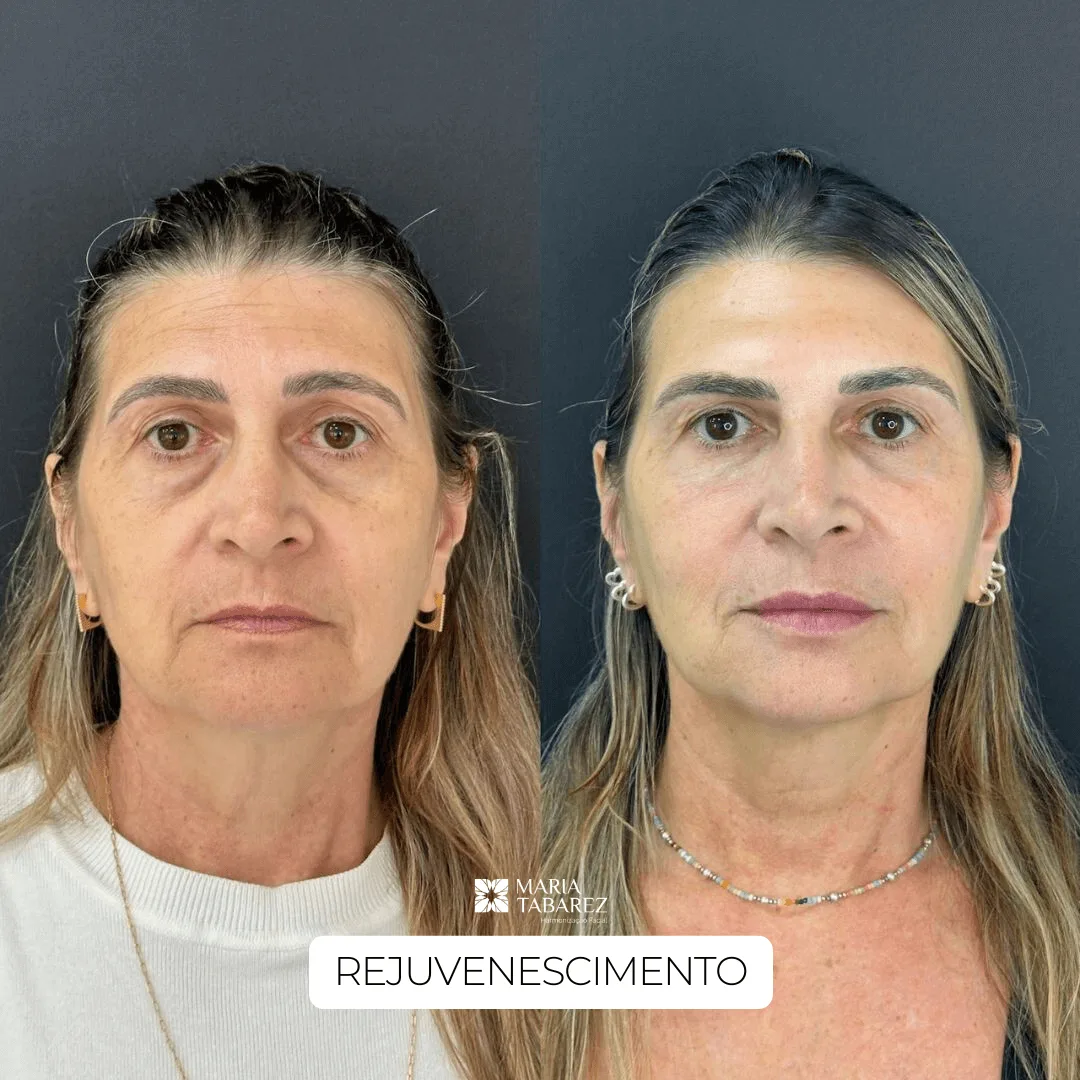 Rejuvenescimento — antes e depois · Maria Tabarez