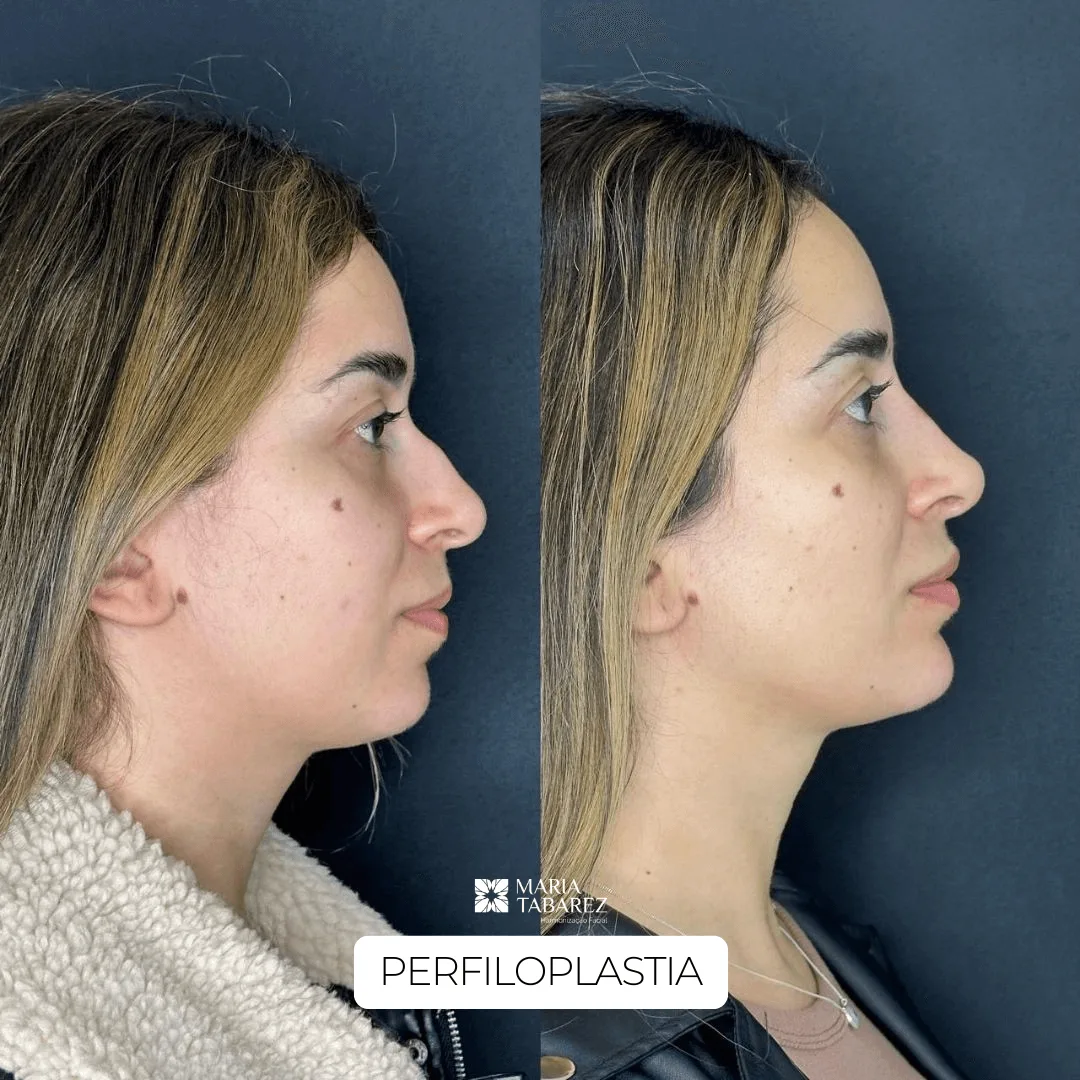 Rejuvenescimento — antes e depois · Maria Tabarez